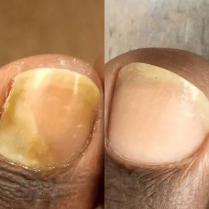 LOOMA - Léčí plísňové infekce a opravit nehty