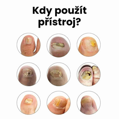 LOOMA - Léčí plísňové infekce a opravit nehty