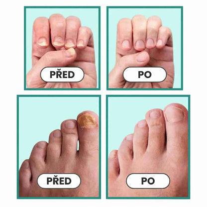 LOOMA - Léčí plísňové infekce a opravit nehty