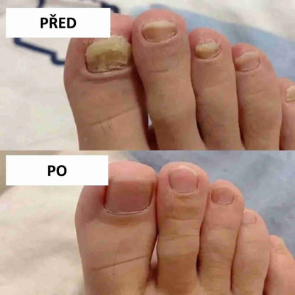 LOOMA - Léčí plísňové infekce a opravit nehty
