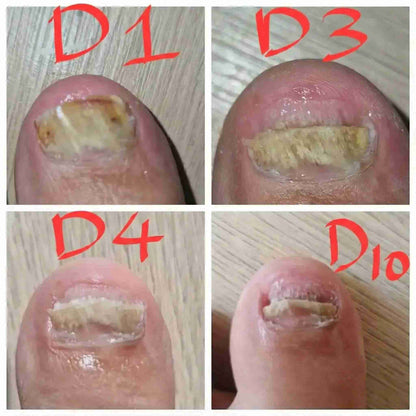 LOOMA - Léčí plísňové infekce a opravit nehty